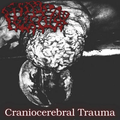 Galactorrhea - Craniocerebral Trauma