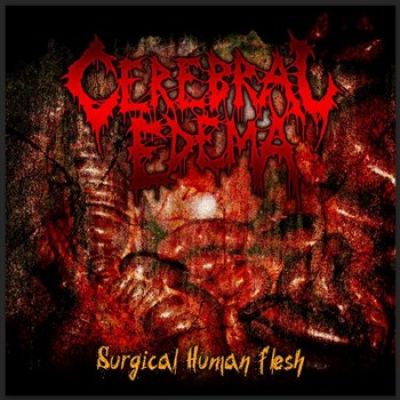 Cerebral Edema - Surgical Human Flesh