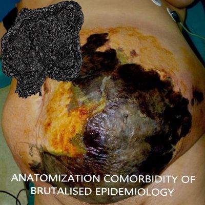 Rancid Lung Capacity - Anatomization Comorbidity of Brutalised Epidemiology