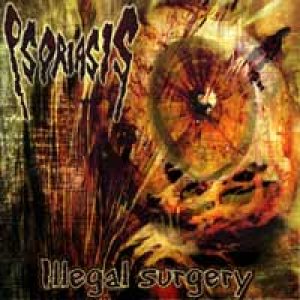 Psoriasis - Illegal Surgery